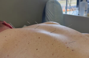 Patient receiving acupuncture treatment with multiple fine needles placed along spine and back