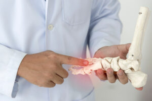 Patient's foot showing bunion requiring foot bunion operation treatment