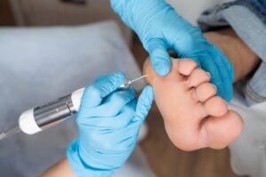 Close-up of foot callus requiring professional treatment and care