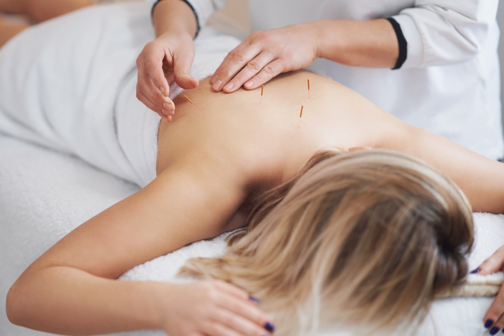 Patient receiving acupuncture treatment with multiple fine needles placed along spine and back