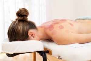 Therapist applying cupping treatment to patient's back with visible suction cups