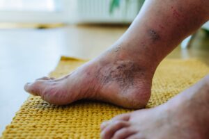 Patient with diabetes receiving neuropathy screening and education