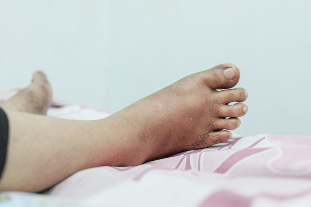 Doctor examining diabetic foot symptoms during neuropathy evaluation's feet for neuropathy symptoms