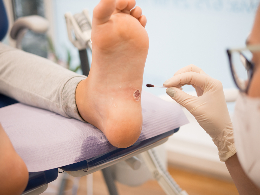 Healthcare provider examining plantar wart on foot during treatment's foot during plantar warts treatment