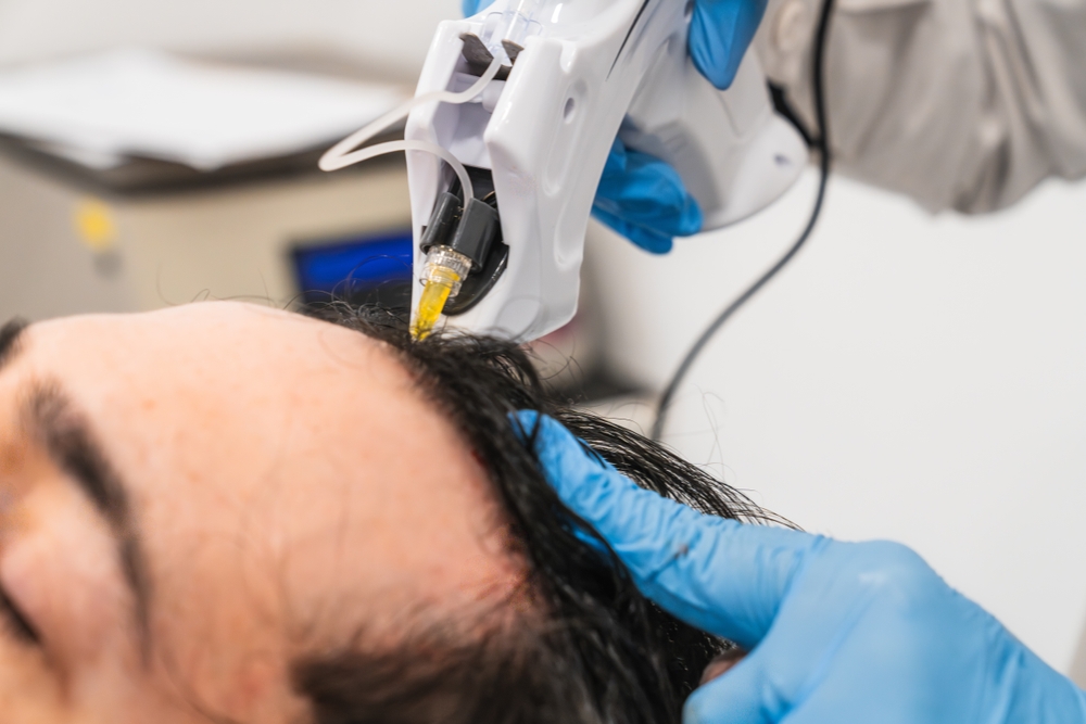 Medical professional administering PRP hair restoration injections