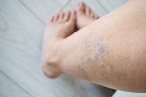 Close-up of spider veins on leg requiring treatment