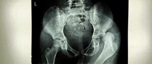 X-ray image of pelvis showing hip joint anatomy relevant to hip acetabular labral tear treatment