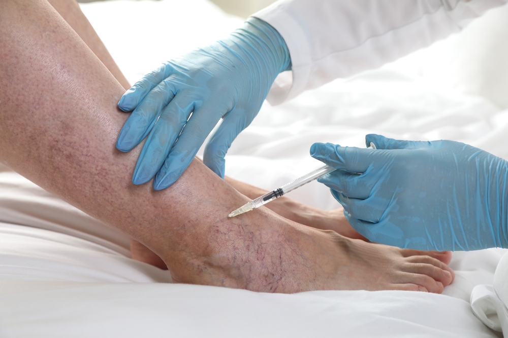Specialist treating varicose veins on patient's foot during vein treatment session