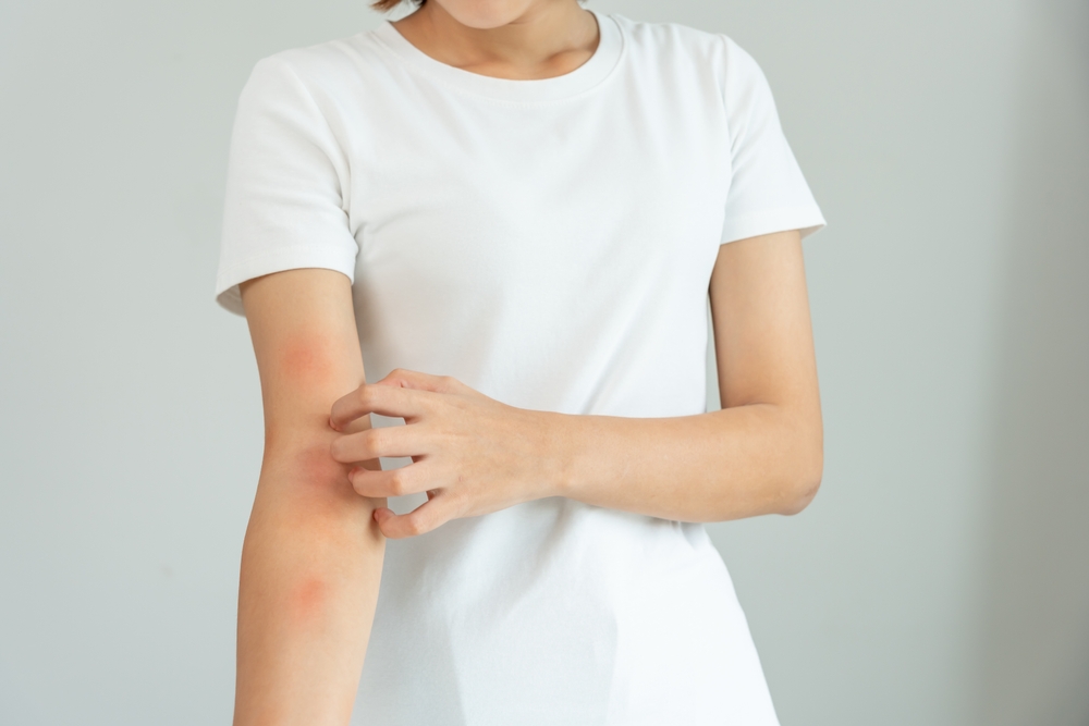 Person experiencing allergic skin reaction with hives on arm