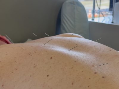 Patient receiving acupuncture treatment with multiple fine needles placed along spine and back
