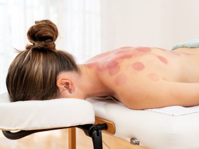 Therapist applying cupping treatment to patient's back with visible suction cups
