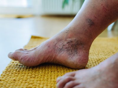 Patient with diabetes receiving neuropathy screening and education