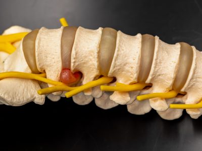 Doctor explaining disc bulge treatment options using spinal anatomy model
