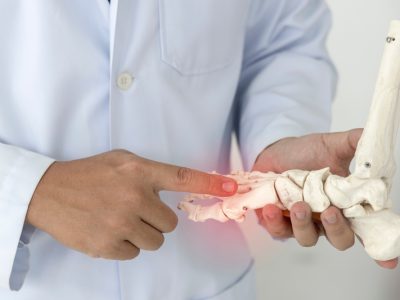Patient's foot showing bunion requiring foot bunion operation treatment