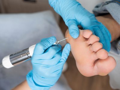Close-up of foot callus requiring professional treatment and care