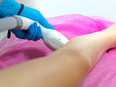 Patient with edema in legs receiving leg swelling treatment evaluation