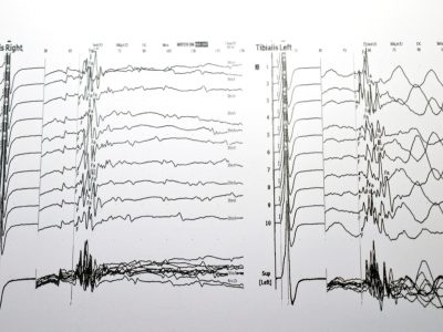 Patient undergoing nerve conduction study with electrodes on leg