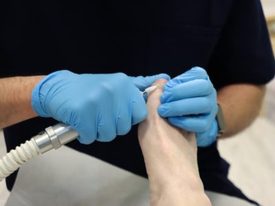 Podiatrist,Using,A,Rotary,Burr,To,Thin,Toenail,Fungal,Infection