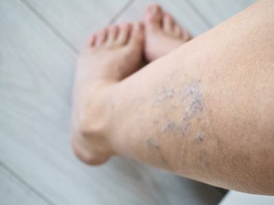 Close-up of spider veins on leg requiring treatment