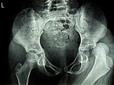 X-ray image of pelvis showing hip joint anatomy relevant to hip acetabular labral tear treatment