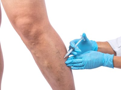 Healthcare provider examining patient during venous insufficiency treatment consultation